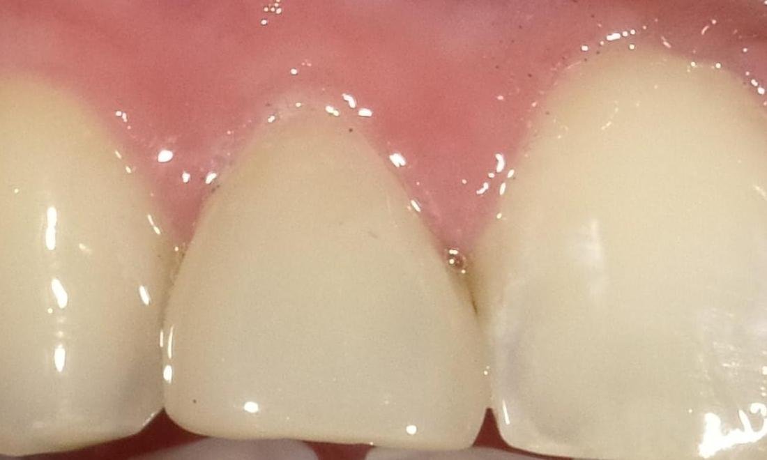After — Anterior Tooth Bonding