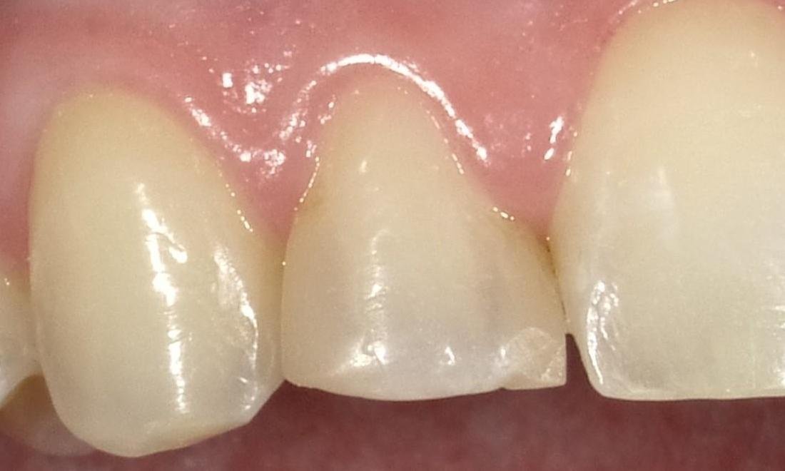 Before — Anterior Tooth Bonding