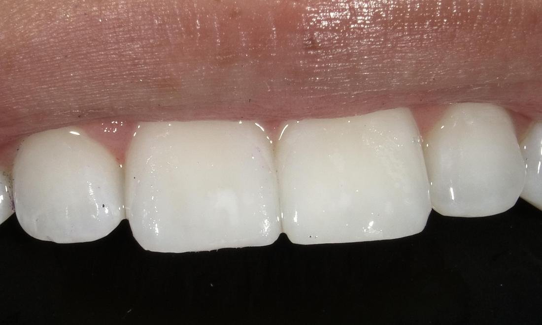After — Resin Infiltration for White Spots