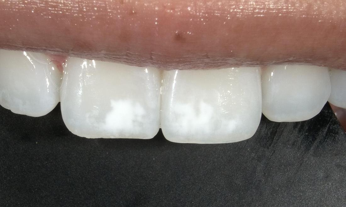 Before — Resin Infiltration for White Spots