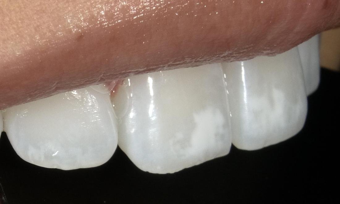 Before resin infiltration treatment for white spots, second case